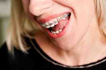 Orthodontist Georgetown Solutions for Crooked Teeth