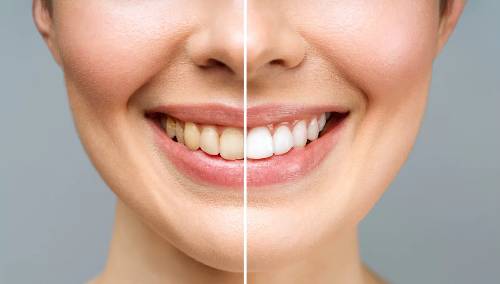 How Much Does Teeth Whitening Costs in Sydney