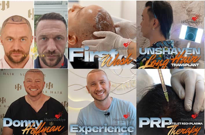 Safe Hair Transplant in Turkey: Sule Hair Transplant