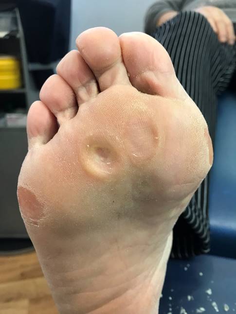 Common Warts: Symptoms and Causes