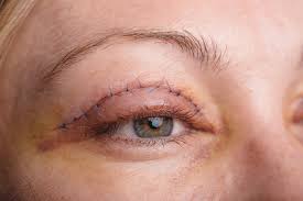 Eyelid Surgery in Dubai