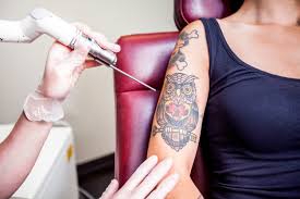 Aftercare Tips for Laser Tattoo Removal in Islamabad