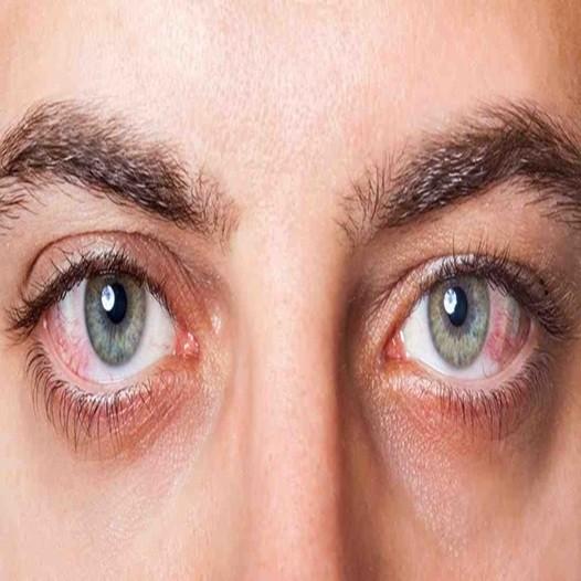 How to Prevent Dry Eyes in a Screen-Focused Lifestyle
