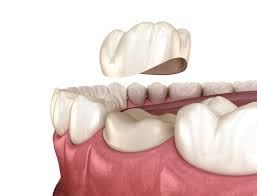 Crown vs Filling: When a Tooth Needs a Cap?