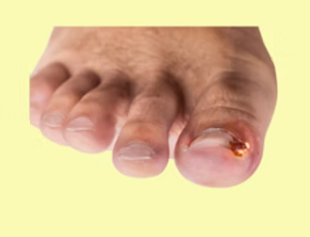 Ingrown Toenail 1