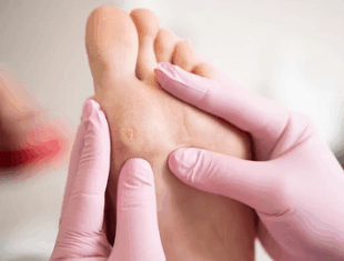 Callus Removal Singapore 1