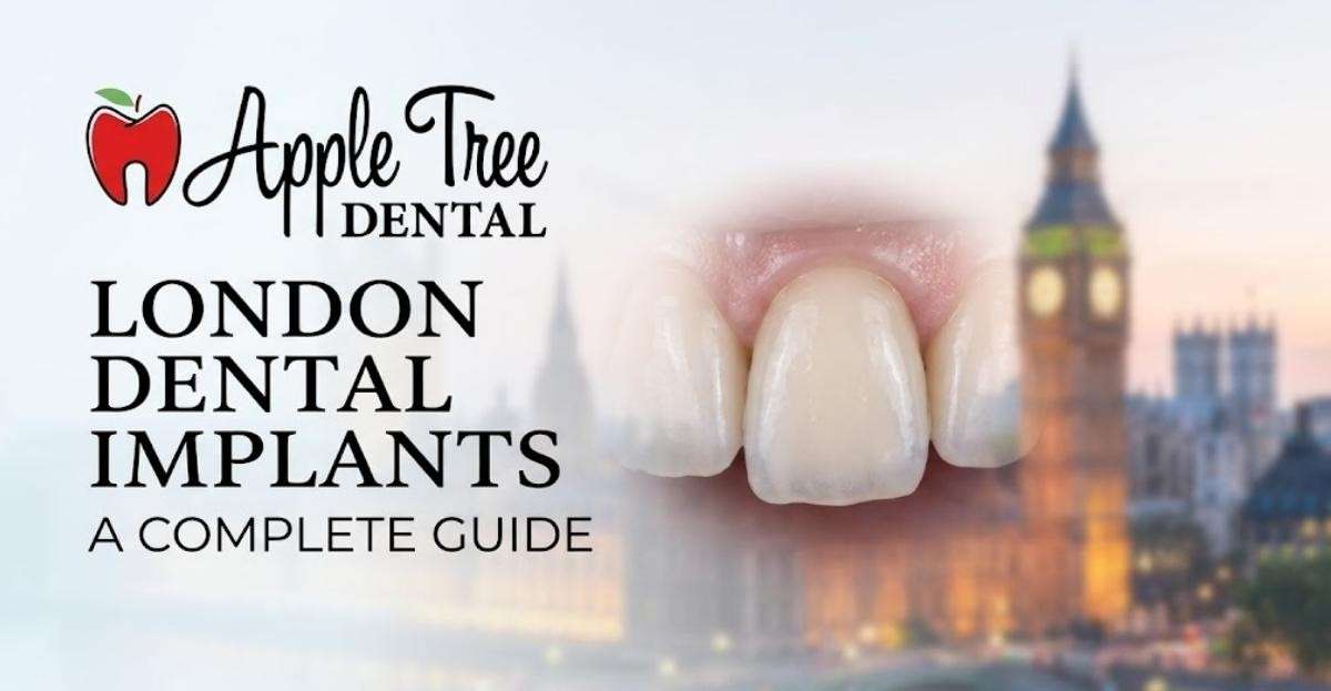 London Dental Implants: A Complete Guide