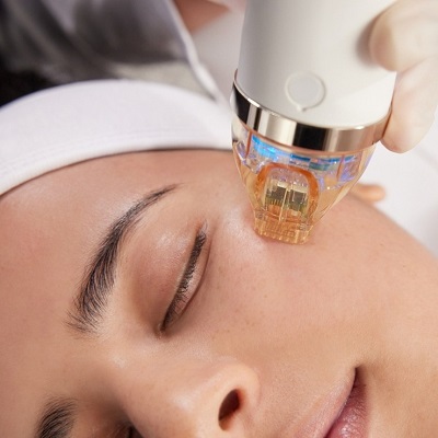 Microneedling Therapy for Collagen Boost and Elasticity