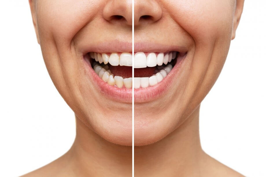 How Veneers Can Fix Chips, Gaps, and Stains Instantly