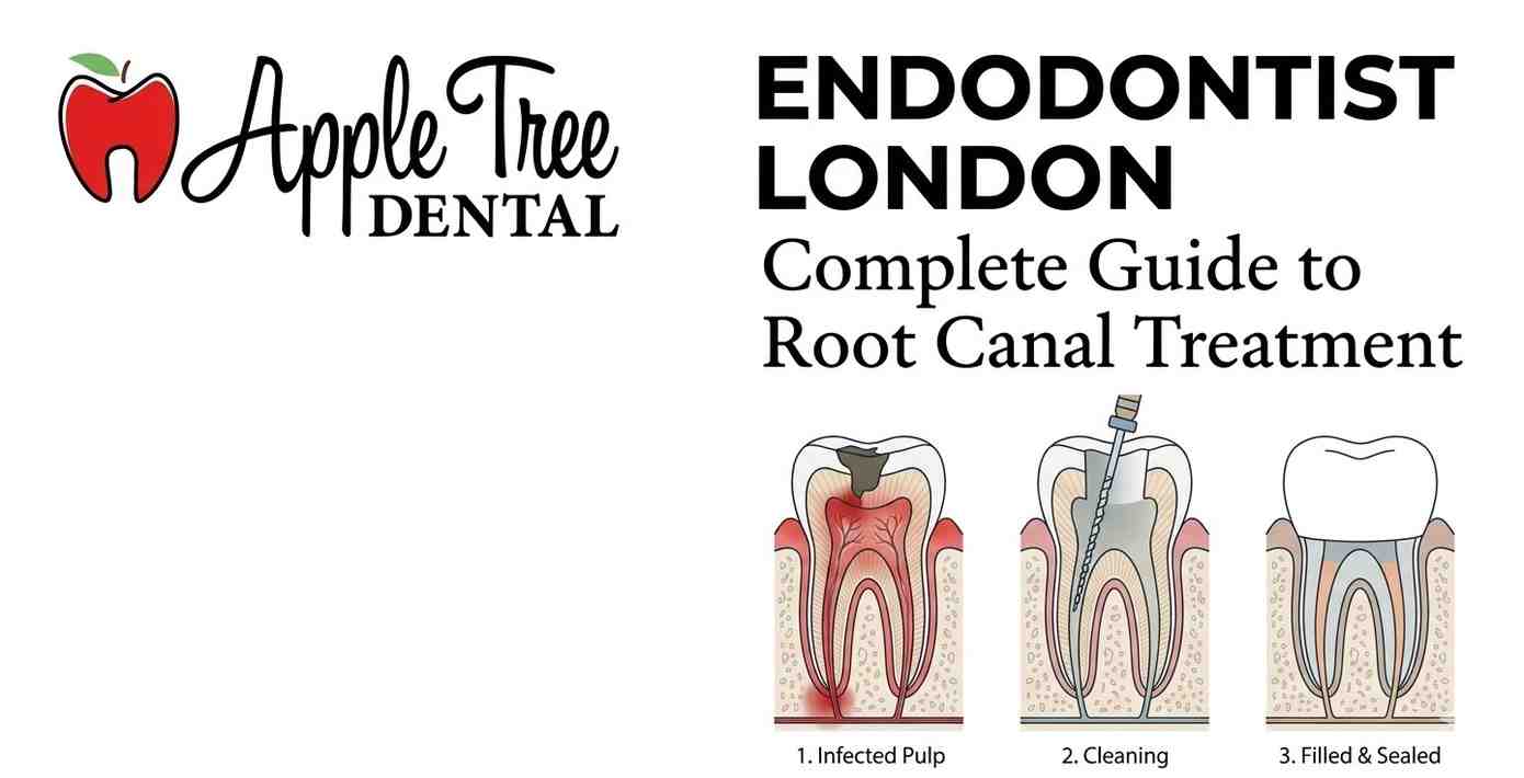Endodontist London: Complete Guide