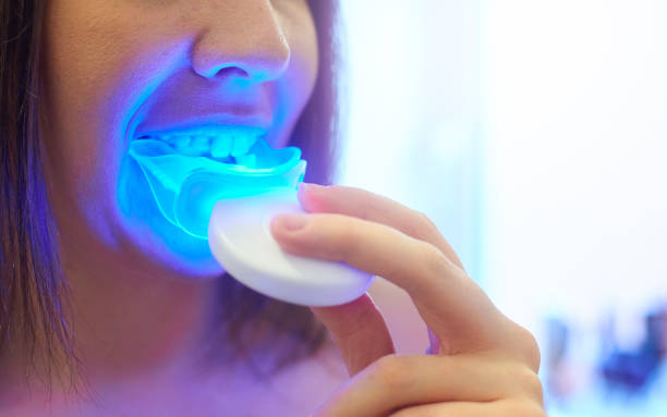 Professional vs Home Teeth Whitening: What Works Best