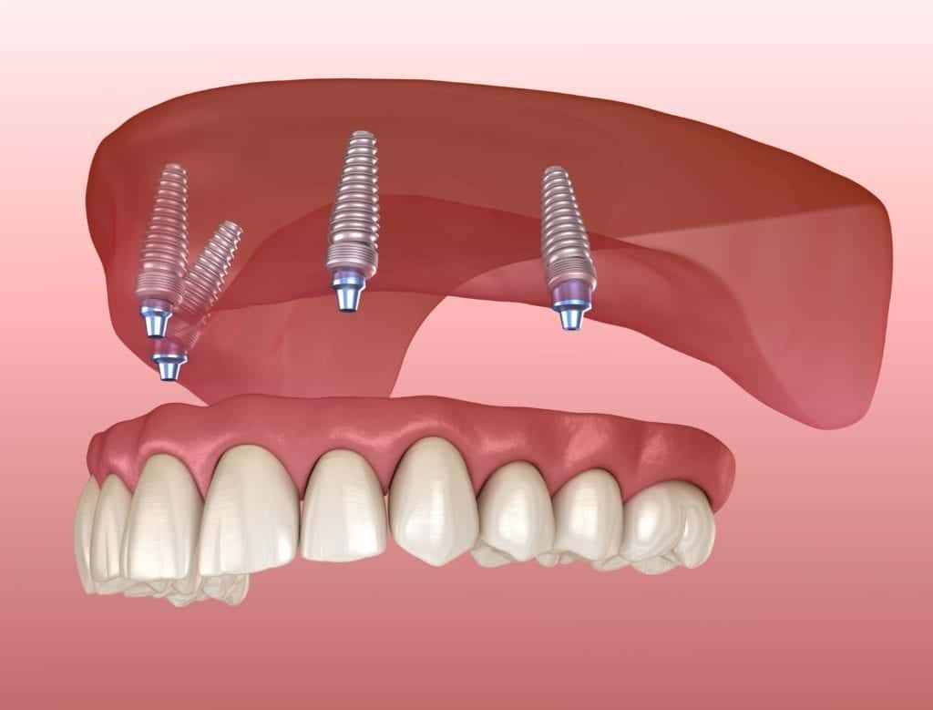 Custom Dental Replacements Fail When Treatment Planning