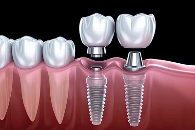 Prosthodontic Implants Help Protect Bone and Bite