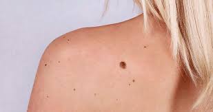 Is Mole Removal in Islamabad Safe? Expert Advice
