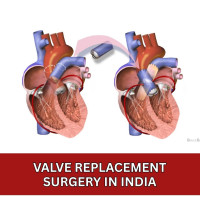 Valve Replacement Surgery in India