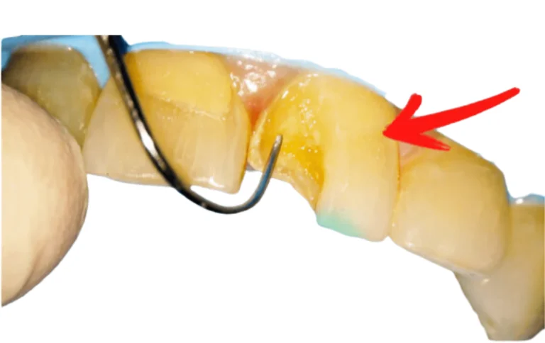 Why Is Tartar Breaking Off My Teeth? Complete Guide