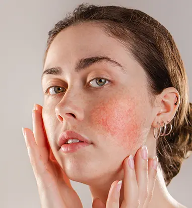 Evaluating Different Rosacea Treatment