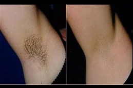 Advanced Care for Sweaty Armpits in Islamabad