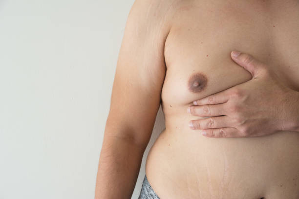 Gynaecomastia Surgery in Dubai: Real Transformation