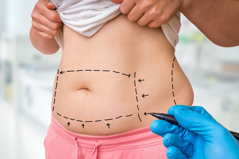 Why People Choose Tummy Tuck After Weight Loss