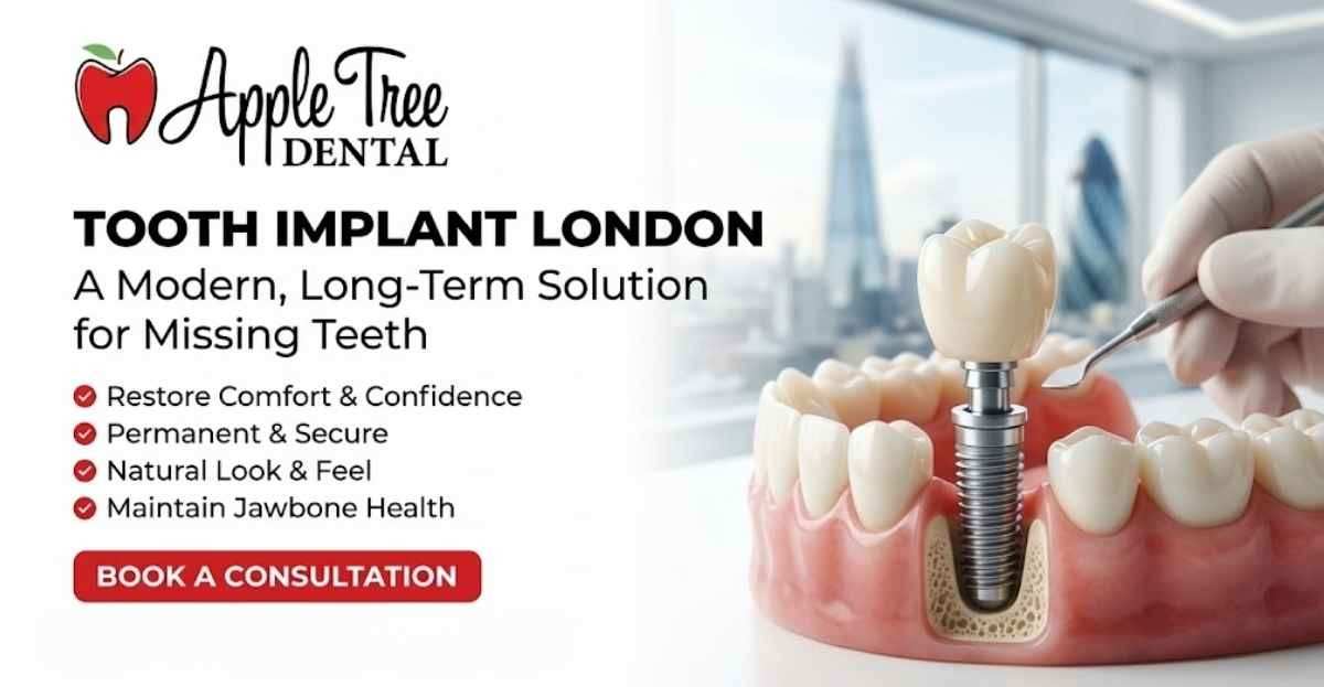 Tooth Implant London: A Modern, Long-Term Solution