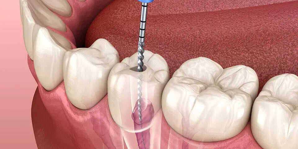 Root Canal Therapy in Suffern: Myths vs. Facts
