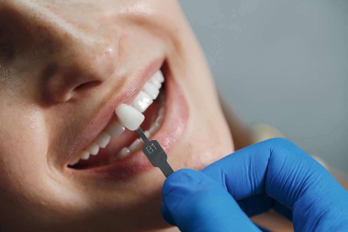 How Long Do Dental Implants Last?