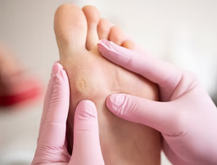 Callus Removal Singapore 5