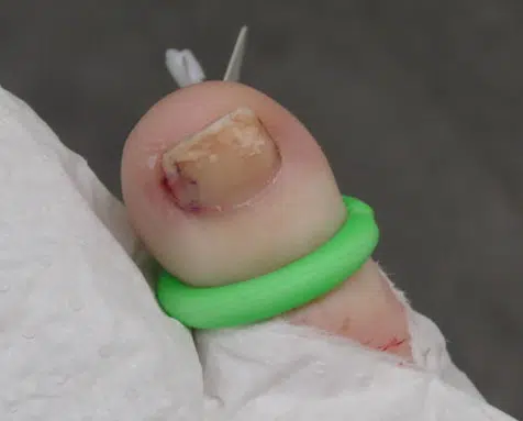 Will an Ingrown Toenail Go Away?