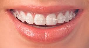 Are Dental Clips Better Than Braces?