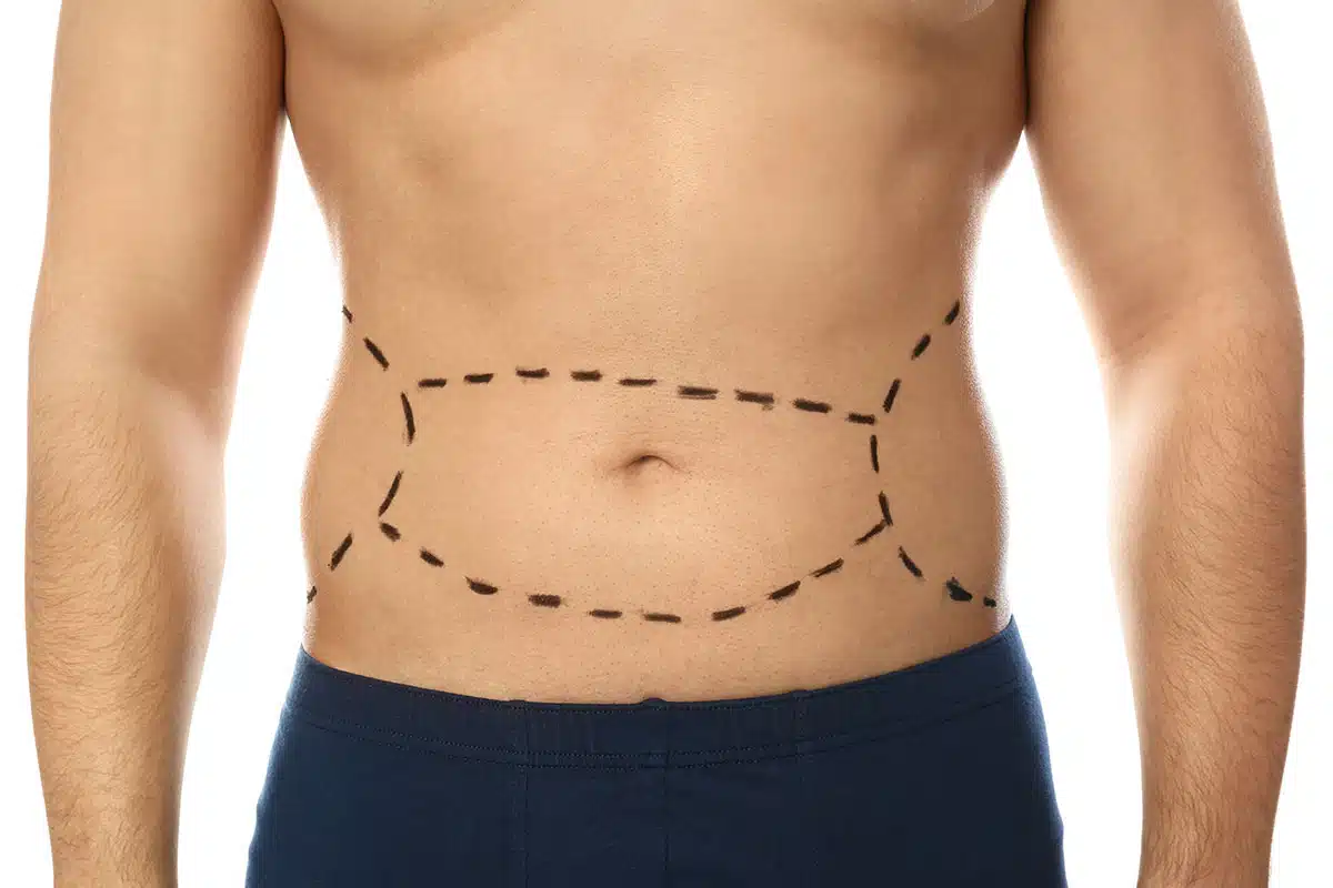 Experience Premium Tummy Tuck Surgery in Islamabad