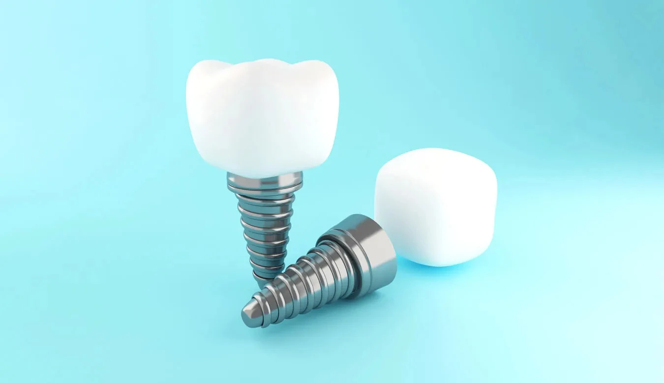 The Complete Guide to Dental Implants