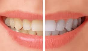 Smile Makeover Teeth Whitening In MVP Colony, Vizag