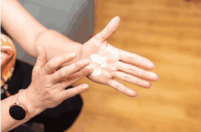 Vitiligo Pathophysiology and Homeopathy