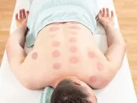 Benefits of Cupping Therapy for Office Workers