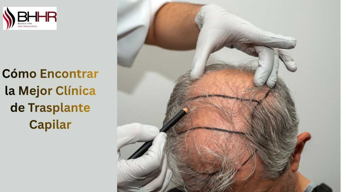 Cómo Encontrar la Mejor Clínica de Trasplante Capilar
